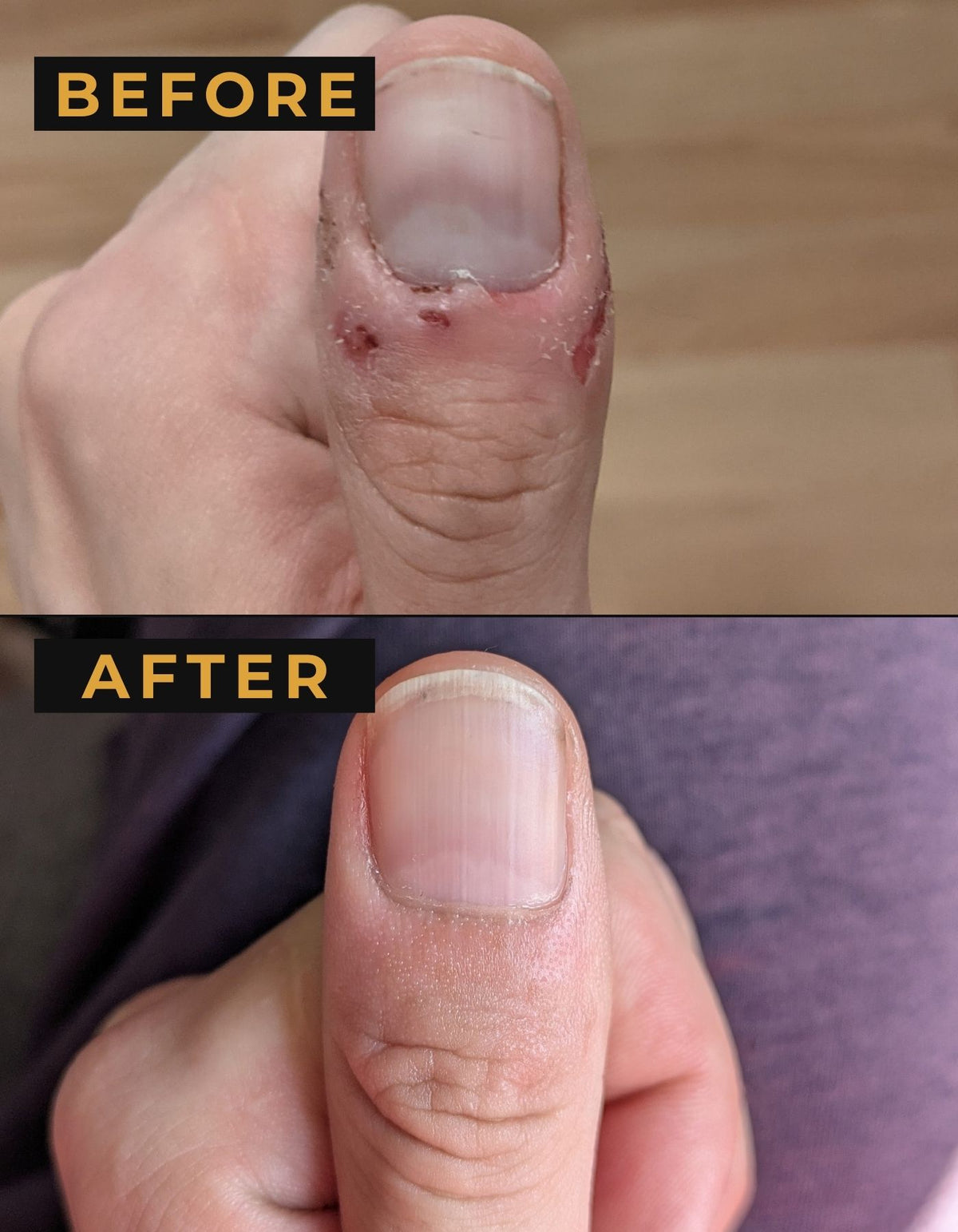 Founder’s thumb before and after 30 days: bitten, raw cuticle above, healed skin below.